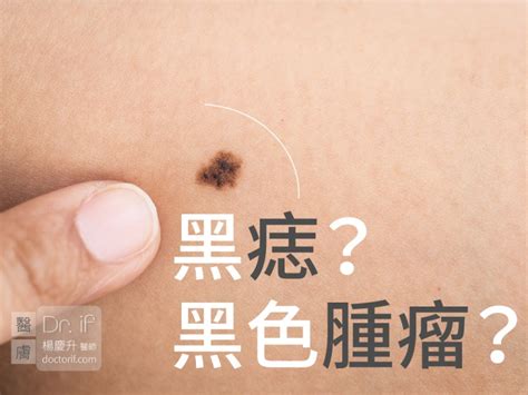 黑痣凸起|不大驚小怪！如何辨別「黑痣」與「黑色腫瘤」？ 